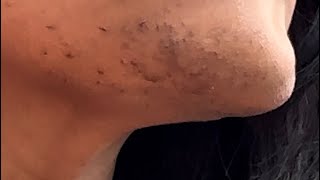 INGROWN HAIR REMOVAL 75 [upl. by Rentschler30]