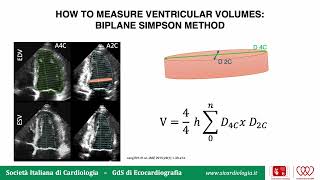 Valutazione ecocardiografica della frazione di eiezione del ventricolo sinistro [upl. by Higbee407]