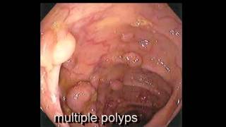 Colonoscopy FollowUp of Colon Polyp  Los Angeles Colonoscopy [upl. by Hollyanne]