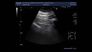 Ascaris Lumbricoides in Gut loops [upl. by Gnud]