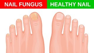 Simple Home Remedies for Toenail Fungus [upl. by Anitsyrhk]