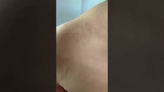 Pityriasis Rosea  Sanjeevani Skin Clinic India [upl. by Kcireddor]