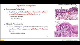 hypertrophy metaplasia [upl. by Naek]