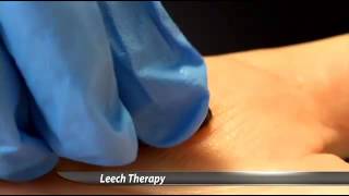 Hospital Uses Leeches to Heal Patients [upl. by Mlehliw]