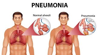 Pneumonia in hindi  Pneumonia के लक्षण  निमोनिया के लक्षण और उपाय Pneumonia in children [upl. by Aicirtel142]