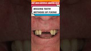 कौन कौन से तरीके हैं उपलब्ध नए दांत लगाने के RPDBridgingImplants missingteeth [upl. by Aliuqehs898]