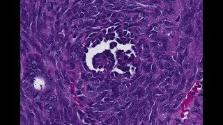 Nephroblastoma Wilms tumor [upl. by Enrobyalc]