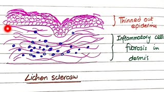 Lichen Sclerosus And Lichen Simplex Chronicus  Pathology [upl. by Lanos360]