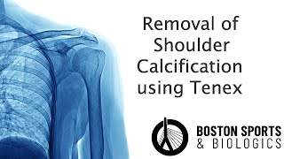 Shoulder Calcification Minimally Invasive Tenex [upl. by Kylynn149]