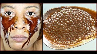 REMOVE DARK CIRCLES EYES BAGS PUFFY EYES  WRINKLES 100 EFFECTIVE Khichi Beauty [upl. by Sucramraj84]