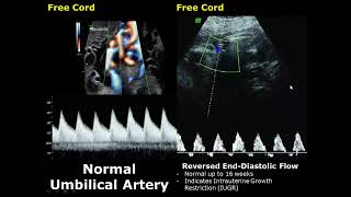 Umbilical Artery Doppler Ultrasound Normal Vs Abnormal Image Appearances  Spectral Doppler USG [upl. by Antonie939]