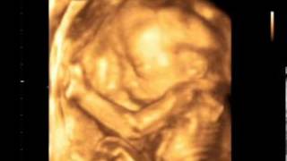 3D4D УЗИ 21 неделя 3D4D Ultrasound scan baby 21 Weeks [upl. by Acirema]