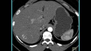 Abdomen Liver Hemangioma of the Liver1 of 8 [upl. by Yarased454]