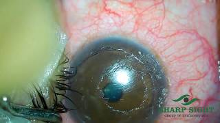 Management of LASIK FLap FoldsStriae [upl. by Eenolem]