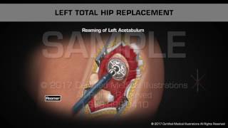 Left Total Hip Replacement Animation [upl. by Anayek]