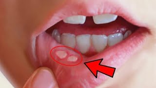 Canker sore  how to get rid of canker sores fast inside your mouth [upl. by Konstantin]