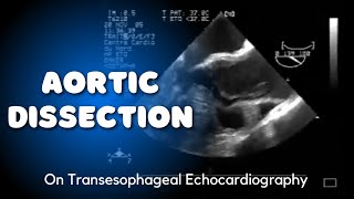 Type A  Aortic Dissection on Transesophageal Echocardiography [upl. by Notsa293]