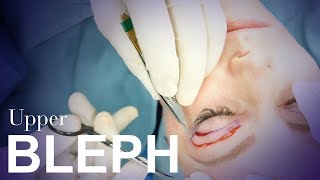 Upper Eyelid Blepharoplasty [upl. by Wrench]