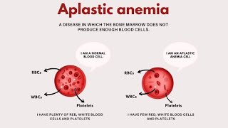 Aplastic Anaemia  Characteristics Causes Symptoms Diagnosis and Treatment [upl. by Esor]