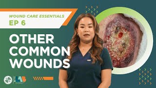 Wound Care Essentials Video 6 – Other Common Wounds [upl. by Bender581]