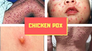 What is Chicken pox Pictures Signs and Symptoms of Chickenpox Virus Varicella [upl. by Bolitho512]