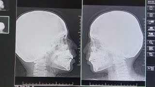 x ray Nasal bone Both Lateral view  Nose fracture  x ray position  Trauma [upl. by Yblok]