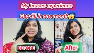 braces vlog🦷 getting braces bracestretment bracesjourney motivation hansikavlog2900 [upl. by Yleme]