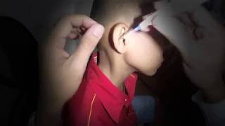 Little Boys Hard Earwax Removal [upl. by Bartolome]