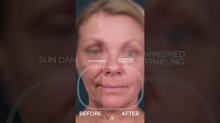 CO2 Laser Resurfacing for Facial Rejuvenation [upl. by Iney]