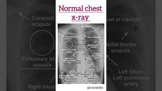 Normal chest xray  shortsvideo xray normalxray [upl. by Hester]