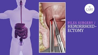 Your Ultimate Guide to Piles Surgery Hemorrhoidectomy [upl. by Sivi]