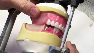 Mandibular anterior setup [upl. by Ajar]