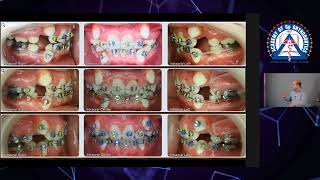 Monday Tip Importance of Cephalometric Analysis in Extraction Cases [upl. by Dikmen]