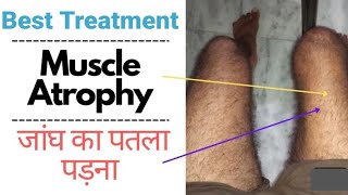 possibility in muscular dystrophy treatment with homeopathic medicines  muscular atrophy [upl. by Mossman360]