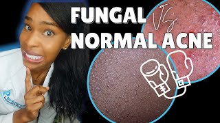 FUNGAL ACNE vs NORMAL ACNE [upl. by Matty]