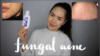 MALASSEZIA FOLLICULITISFUNGAL ACNE Tiny Forehead Bumps  My Experience and Treatment  jskavee [upl. by Judenberg]