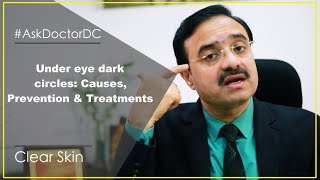 Under eye dark circles Causes Prevention amp Treatments English [upl. by Halyak]