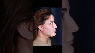 necklift endoscopicnecklift dravsar rhinoplastyinturkey [upl. by Ahseken]