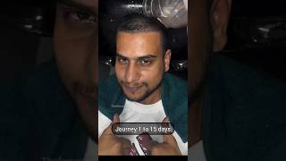 Mehtab saifi hair transplant journey shorts [upl. by Judie877]