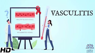 Vasculitis Everything You Need To Know [upl. by Scarrow867]