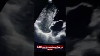 what is the diagnosis Bubble contrast echocardiogram echo [upl. by Goss]