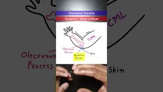 Olecranon Bursitis orthopedics inicet neetpg [upl. by Nylednarb]