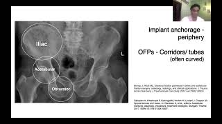 Surgical anatomy of the pelvis and acetabulum [upl. by Xxam]