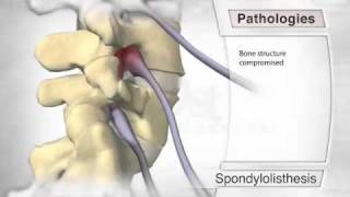 Spondylolisthesis Pathology [upl. by Ocana]