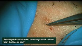 Electrolysis Ingrown Hair Removal  CLOSEUP  Here is how Electrolysis works  Jade Clinics [upl. by Eimmij155]