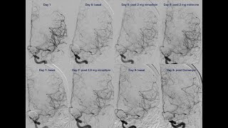 Vasospasm Combined endovascular treatment [upl. by Ikilisav]