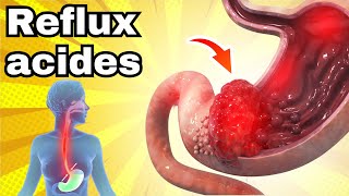 Ne mange pas ces aliments avec le REFLUX ACIDE [upl. by Guinna779]