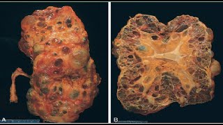 Pathology Urogenital Module  Congenital Anomalies [upl. by Greenfield]