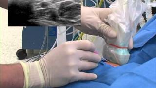 Ultrasoundguided arterial line Placement [upl. by Aisat679]