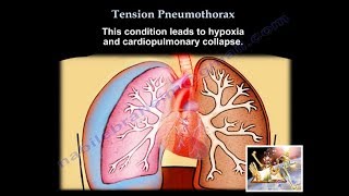 Tension Pneumothorax  Everything You Need To Know  Dr Nabil Ebraheim [upl. by Bunch]